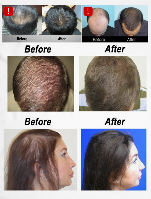 hair replacement the bronx ny
